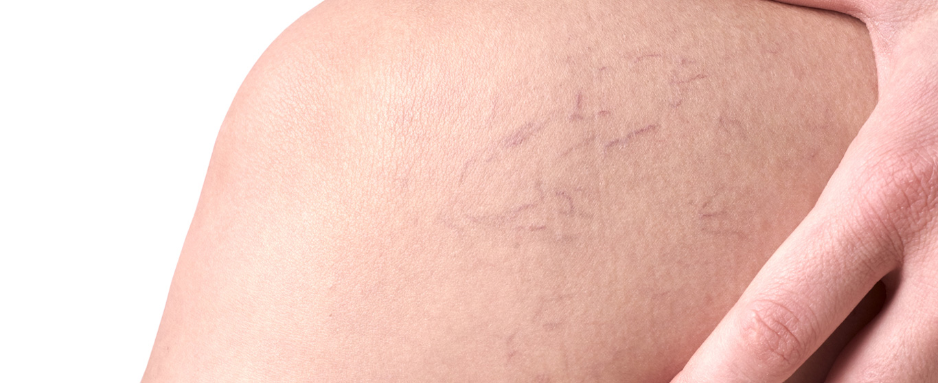 Close-up of visible spider veins on a leg