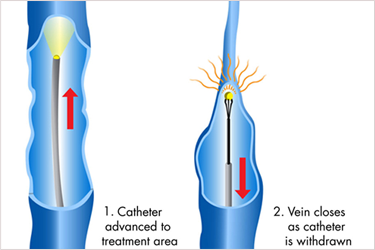 Diagram showing a catheter inside a vein and the vein closing as it is withdrawn