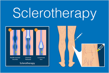 Diagram illustrating sclerotherapy injections and vein closure