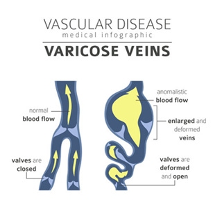 Vascular Disease Infographic 2